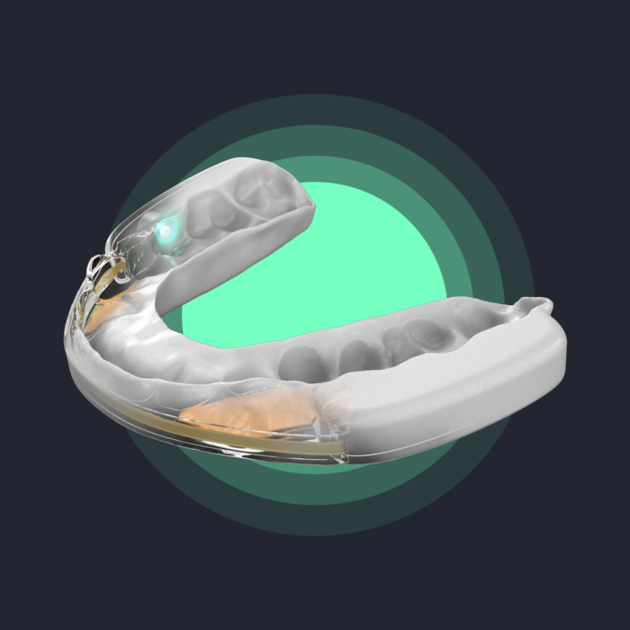 A scientifically validated Sleep Bruxism therapy in a custom-fit oral appliance 